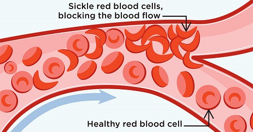 Sickle Cell illustration